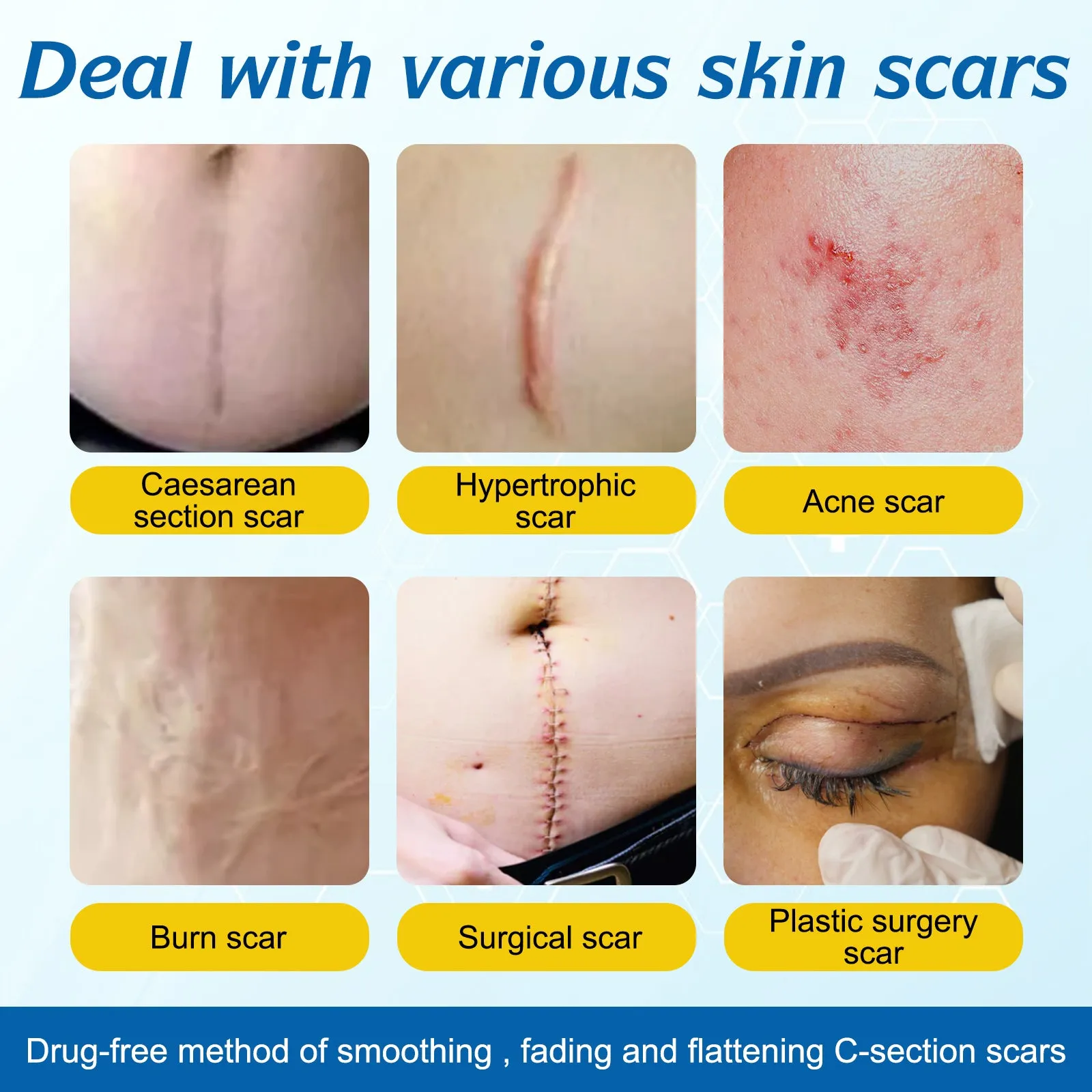 ALIVER Silicone Scar Sheets, Silicone Scar Tape-1.8”x120”, Scar Removal Strips for Acne Scars C-Section & Keloid Surgery Scars Sheets - 6-8 Month Supply