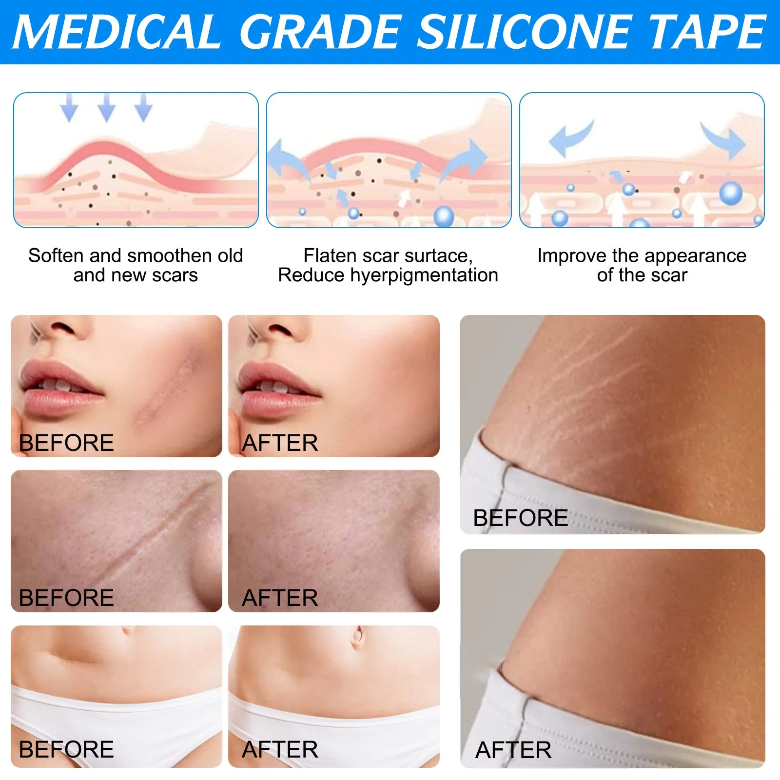 ALIVER Silicone Scar Sheets, Silicone Scar Tape-1.8”x120”, Scar Removal Strips for Acne Scars C-Section & Keloid Surgery Scars Sheets - 6-8 Month Supply