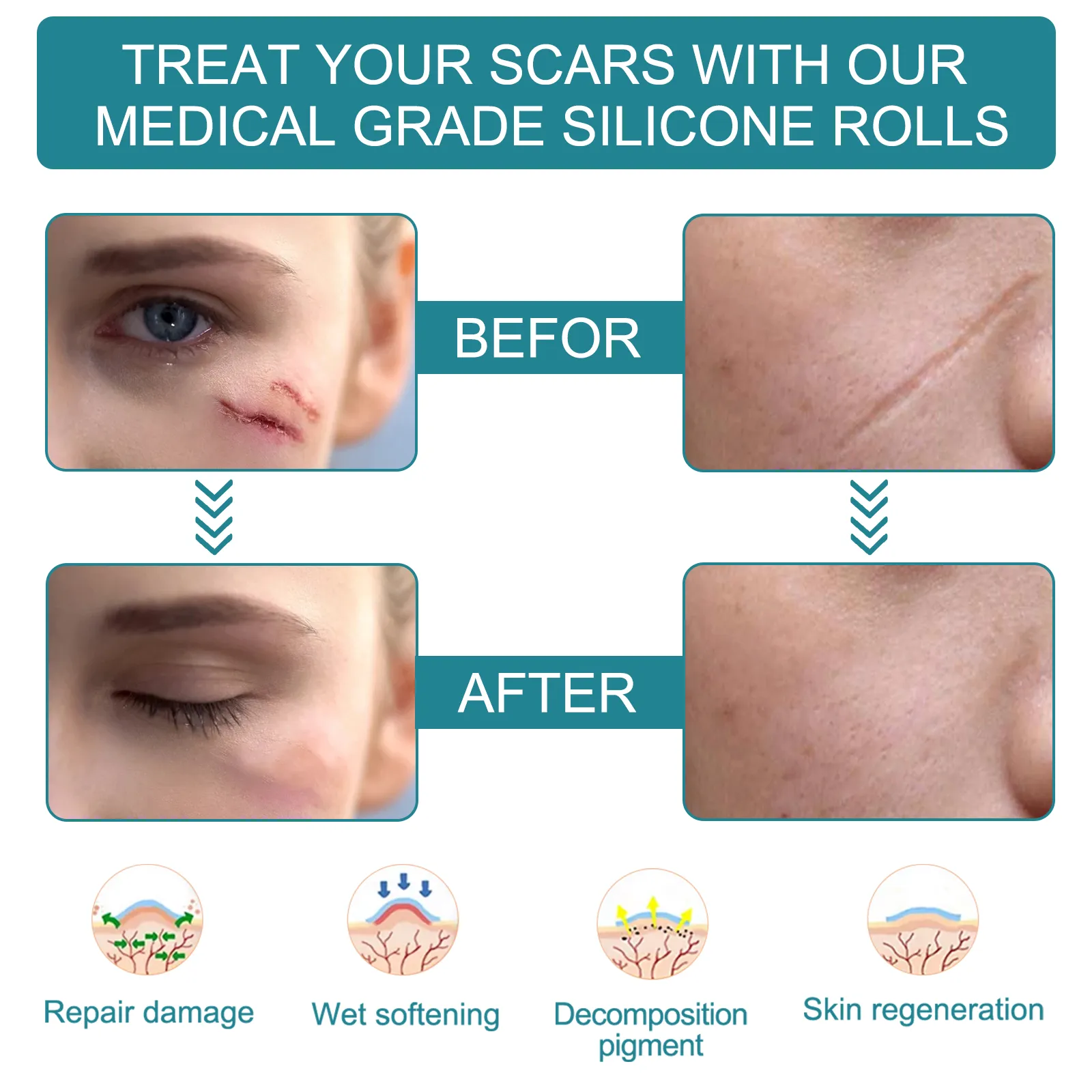 ELAIMEI Silicone Scar Sheets, Silicone Scar Tape, Scar Removal Strips for Acne Scars C-Section & Keloid Surgery Scars Sheets - 6-8 Month Supply